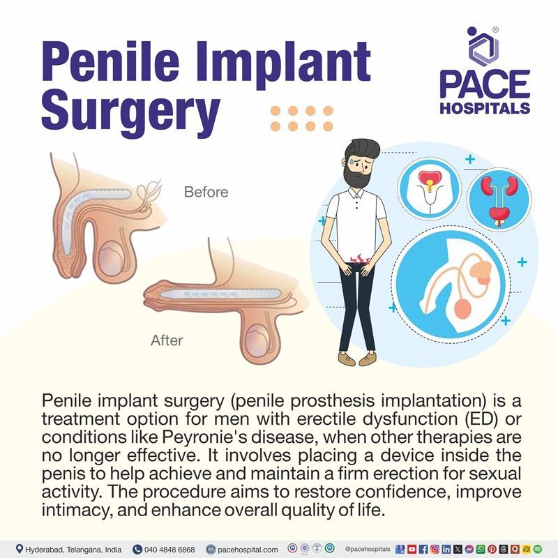 Penile prosthesis implantation | Visual depicting the meaning of Penile Implant Surgery
