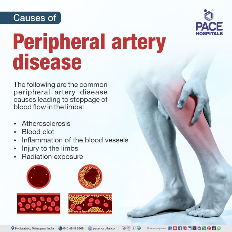 Causes of peripheral artery disease peripheral artery disease causes | main cause of peripheral artery disease | what causes peripheral artery disease | peripheral artery disease causes risk factors | Causes of peripheral artery disease