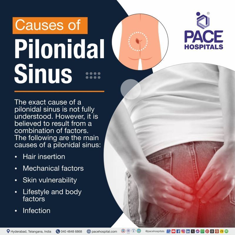 Pilonidal Sinus Causes pilonidal sinus causes | what causes a pilonidal sinus | causes of pilonidal sinus