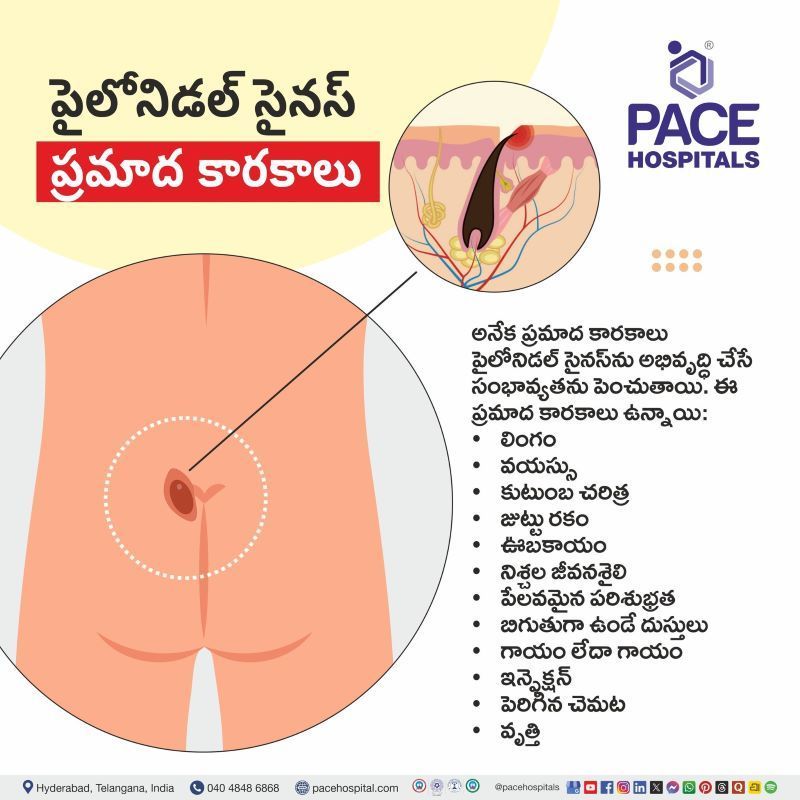 పైలోనిడల్ సైనస్ ప్రమాద కారకాలు | Pilonidal Sinus Risk factors in Telugu Pilonidal Sinus Risk factors in Telugu | పైలోనిడల్ సైనస్ ప్రమాద కారకాలు | Risk factors of Pilonidal Sinus in Telugu