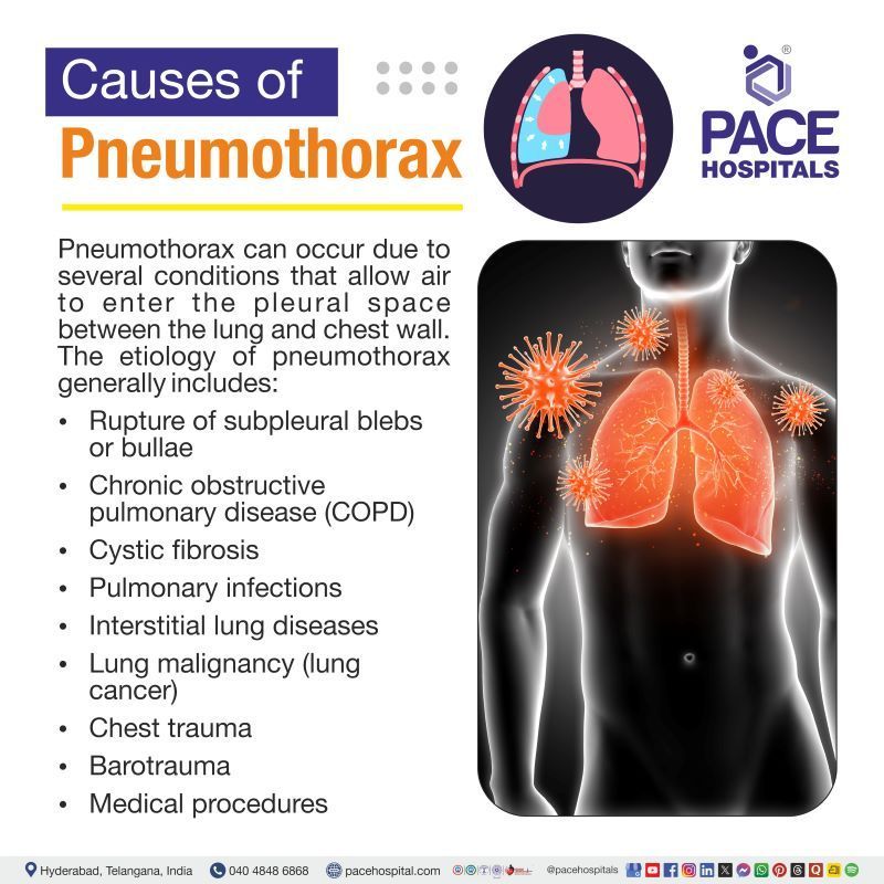 Pneumothorax Causes Pneumothorax Causes | cause pneumothorax | What causes pneumothorax