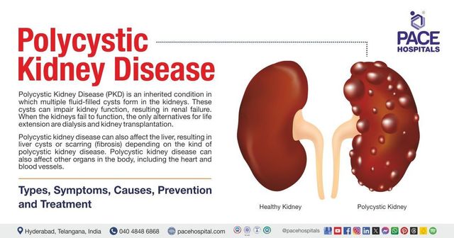 semaglutide polycystic kidney disease lowers UACR in overweight CKD patients Can a patient with autosomal