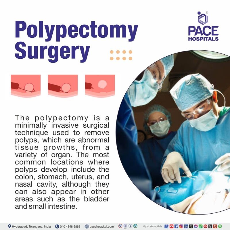 What is Polypectomy Surgery Best Polypectomy surgery hospital in Hyderabad | Best hospital for Polyps Removal Surgery in Hyderabad, India