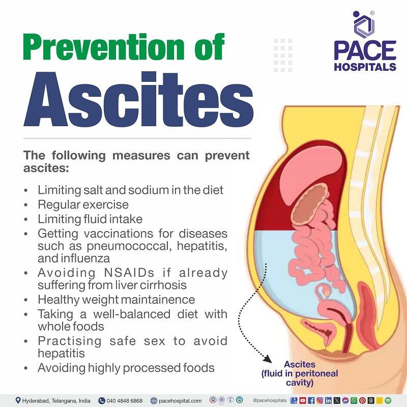 Ascites Preventive measures prevention of ascites | Ascites Preventive measures | Preventive measures of Ascites | Ascites Preventions | Preventions of Ascites | Visual narrating the Preventive measures of Ascites