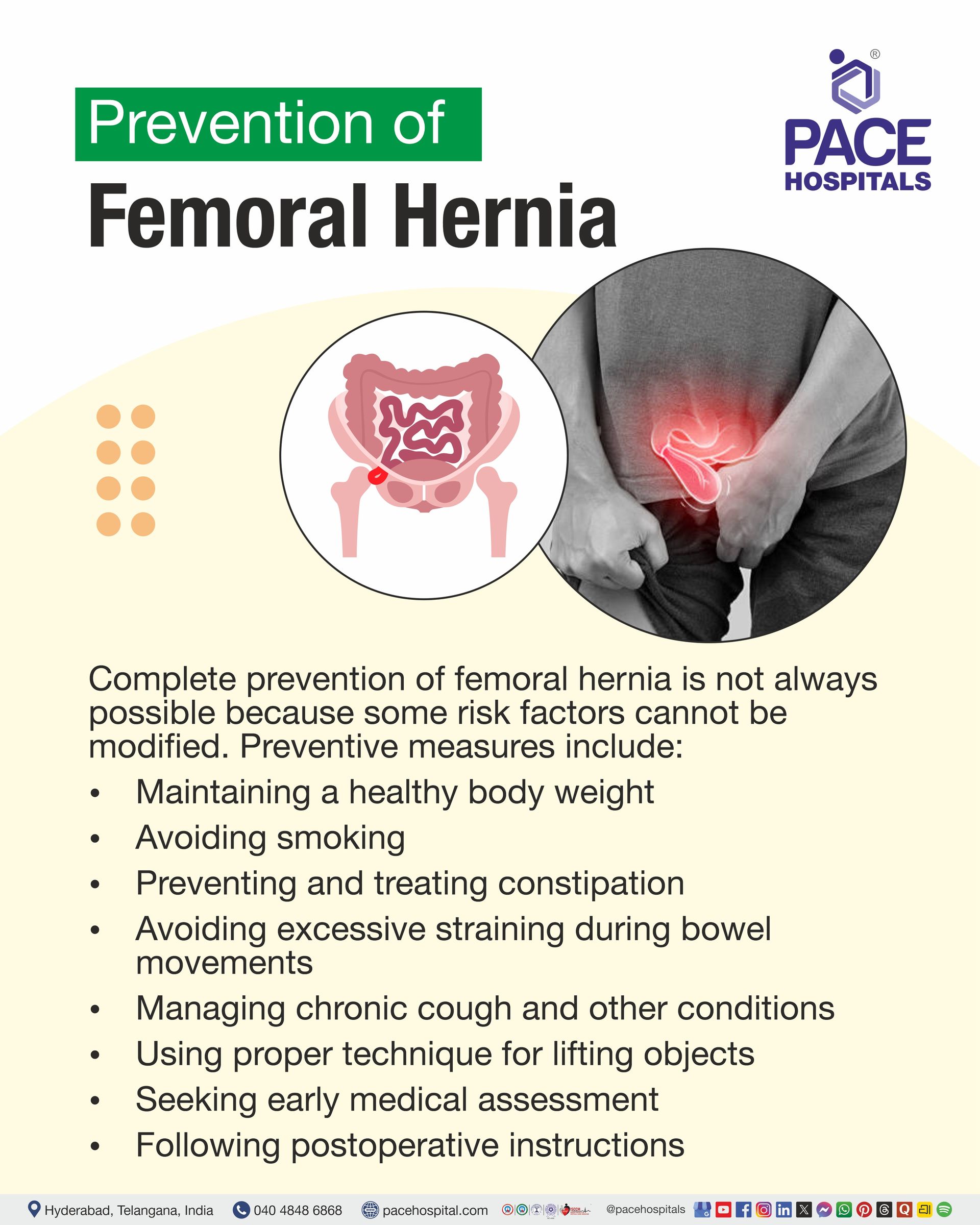Prevention of Femoral Hernia Prevention of Femoral Hernia I Femoral Hernia Prevention