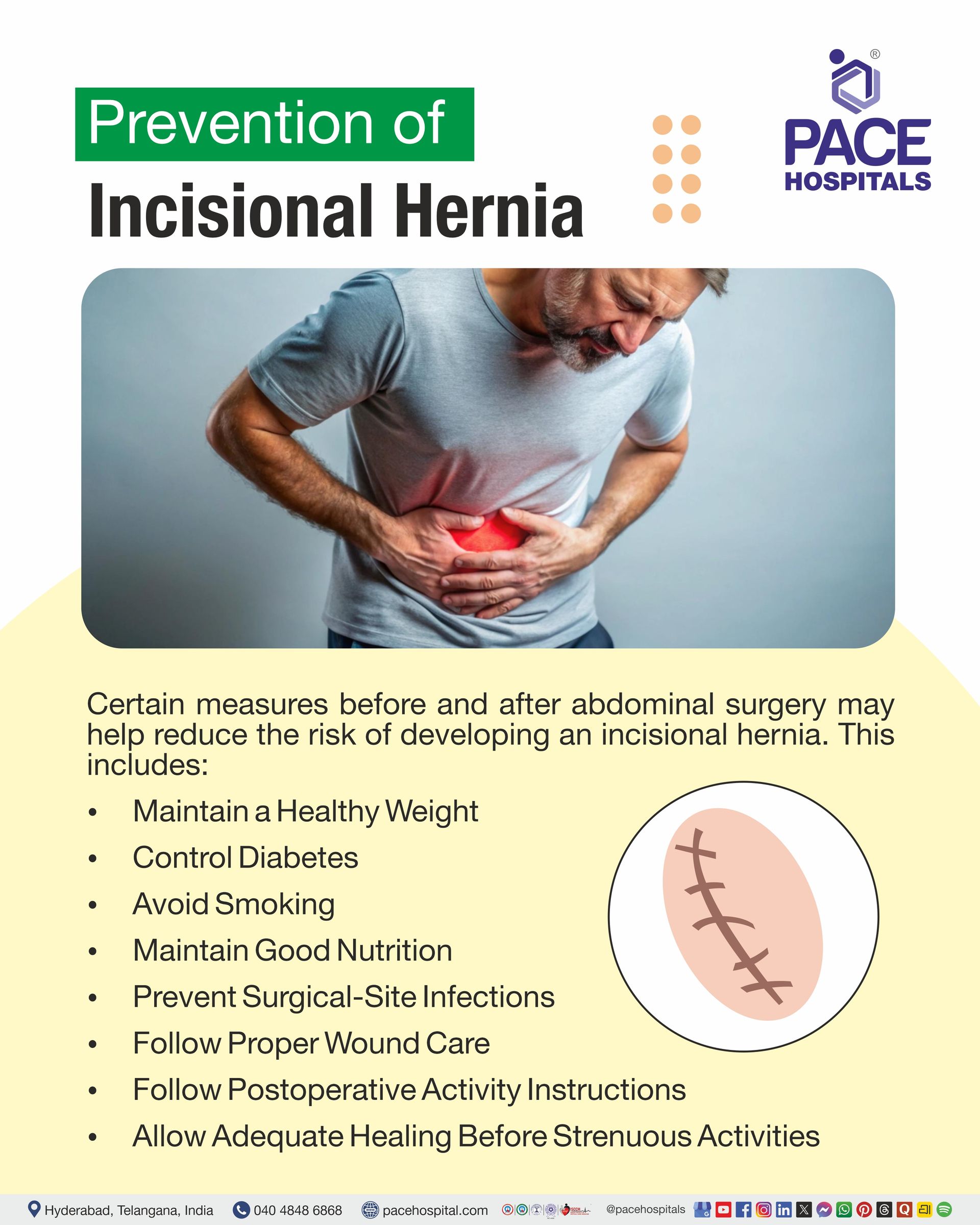 Prevention of Incisional Hernia Prevention of Incisional Hernia I Incisional Hernia Prevention
