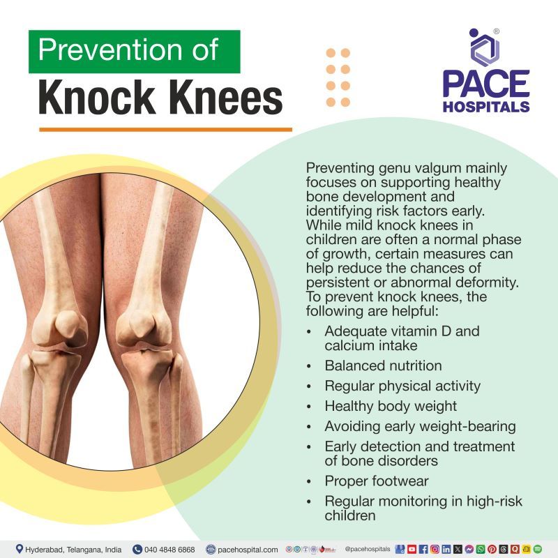 Prevention of Knock Knees (Genu Valgum) Prevention of knock knees | Genu Valgum prevention | How to prevent knock knees