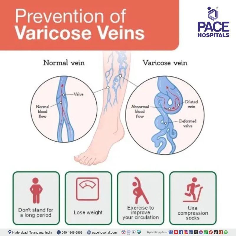 how to prevent varicose veins | varicose veins prevention