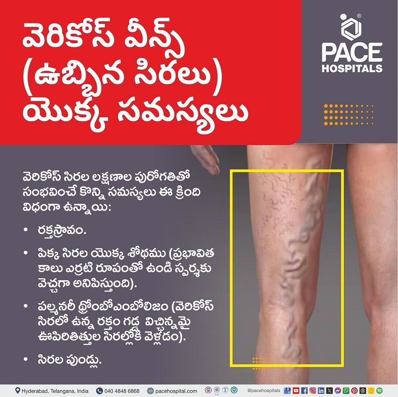 Varicose veins complications in Telugu అనారోగ్య సిరలు యొక్క సమస్యలు ఏమిటి | what are the complications of varicose veins | Varicose complications in Telugu | Complications of Varicose veins in Telugu | అనారోగ్య సిరలు యొక్క సమస్యలు |
అనారోగ్య సమస్యలు