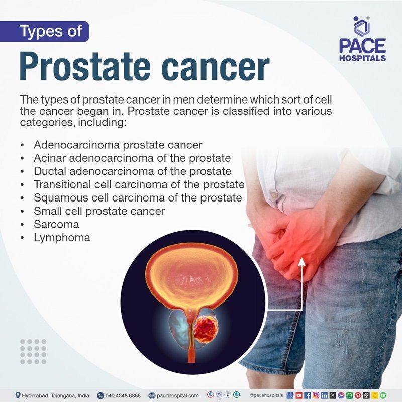 prostate cancer types​ | types prostate cancer​ | what are the five types of prostate cancer​ | aggressive types of prostate cancer​ | different types of prostate cancer​