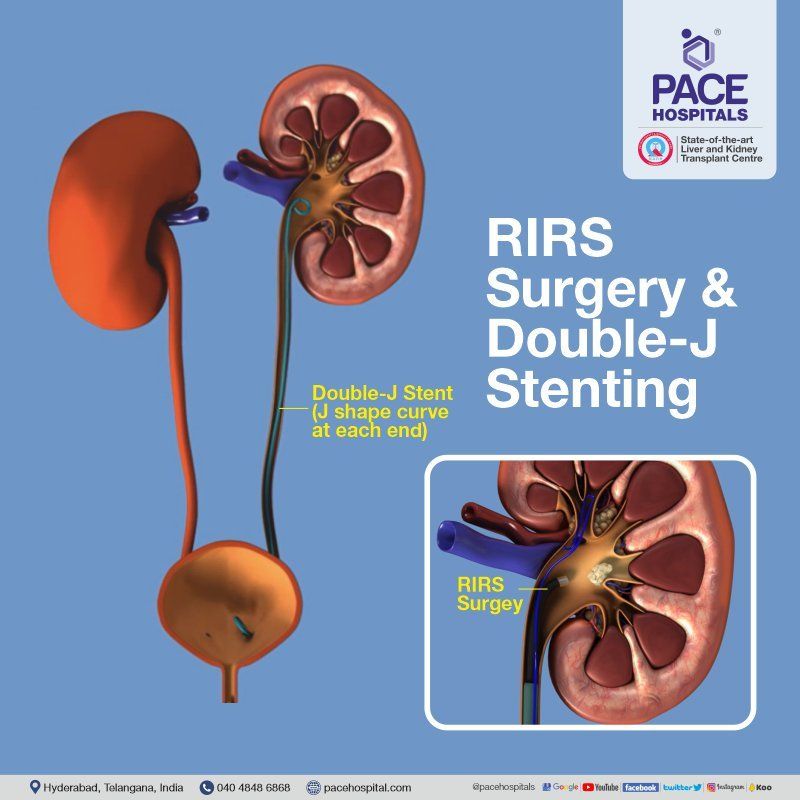 RIRS Surgery and Double- J stent RIRS Surgery and Double- J stent, Retrograde Intrarenal Surgery with DJ stent