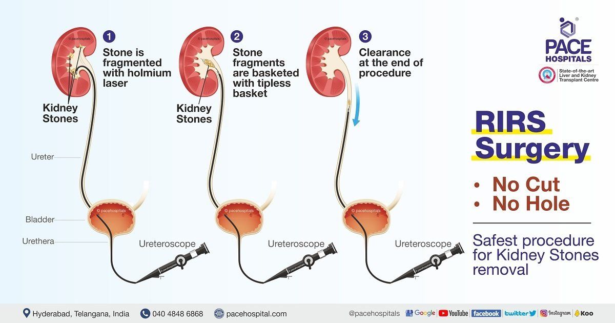 RIRS Surgery benefits, Retrograde Intrarenal Surgery