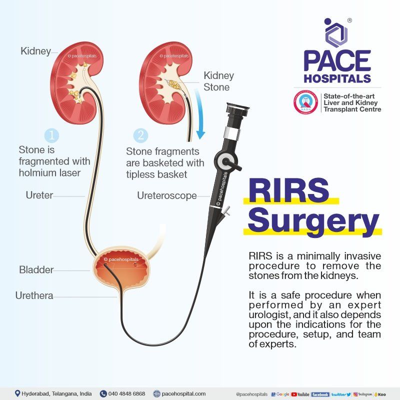 RIRS Surgery in Hyderabad RIRS surgery for kidney stone treatment in hyderabad, RIRS Procedure, Retrograde Intrarenal Surgery