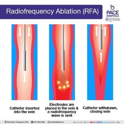 radiofrequency ablation radiofrequency ablation in hyderabad | radiofrequency ablation for varicose veins