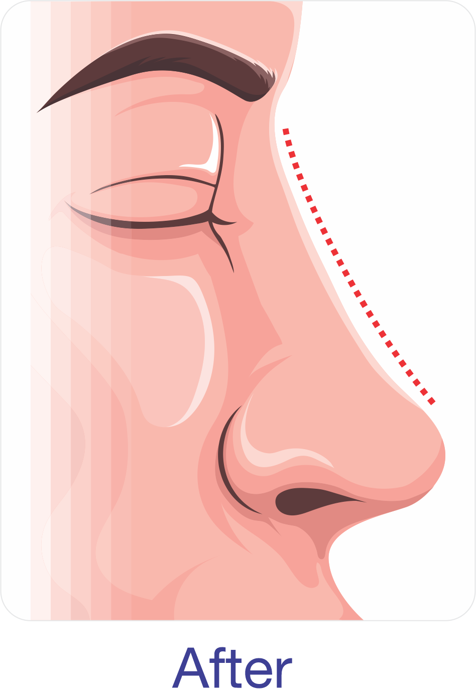 After Rhinoplasty Surgery Rhinoplasty after
