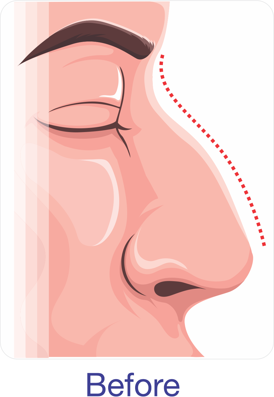Before Rhinoplasty Surgery Rhinoplasty before