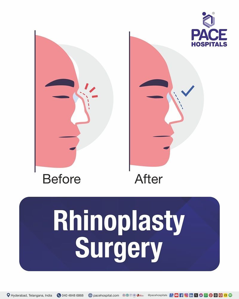 Rhinoplasty Surgery Cost in Hyderabad | Affordable Rhinoplasty Nose Job Procedure in India