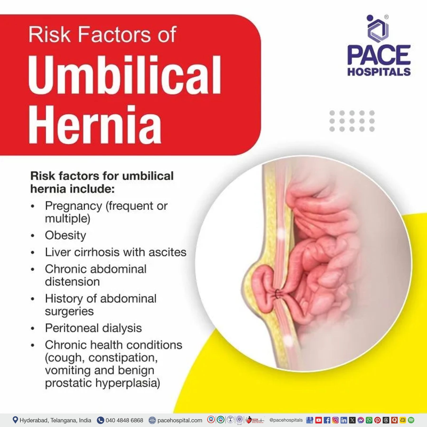 risk factors of umbilical hernia, India | paraumbilical hernia risk factors | umbilical hernia risk of strangulation | umbilical hernia risk factors | belly button hernia risk factors