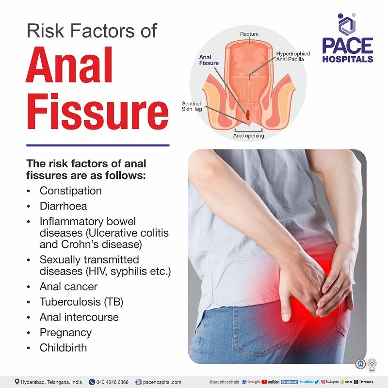 risk factors of anal fissures anal fissure risk factors | risks of anal fissures