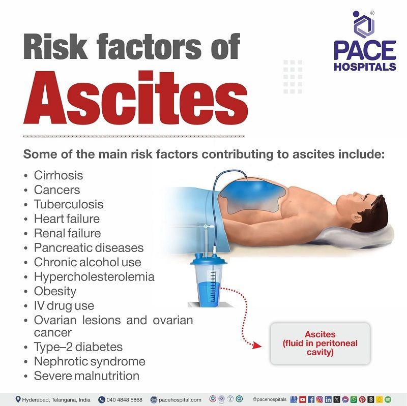 Risk factors of Ascites Risk factors of Ascites | Ascites Risk factors | What are the risk factors of Ascites | Visual depicting the main risk factors contributing to Ascites
