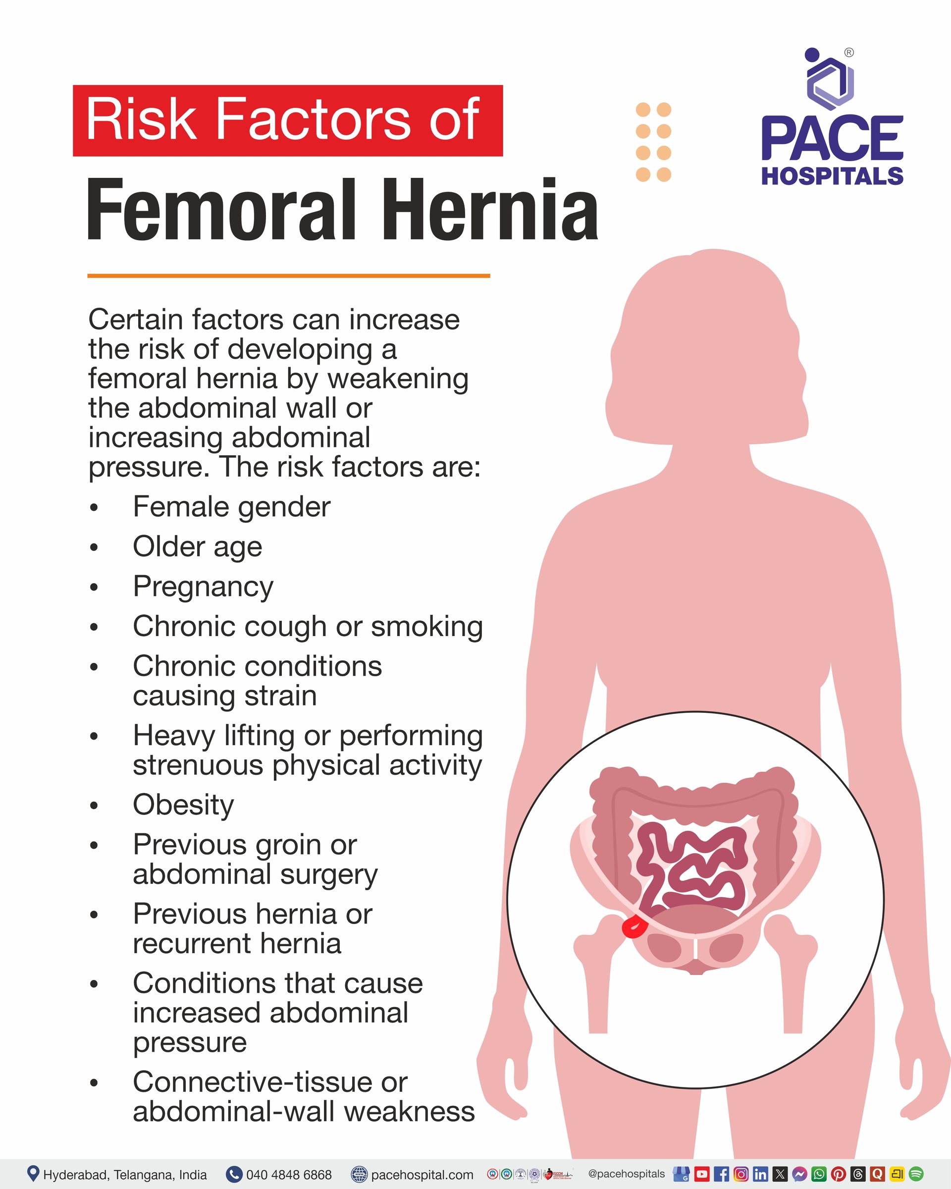 Risk Factors of Femoral Hernia Risk Factors of Femoral Hernia I Femoral Hernia Risk Factors