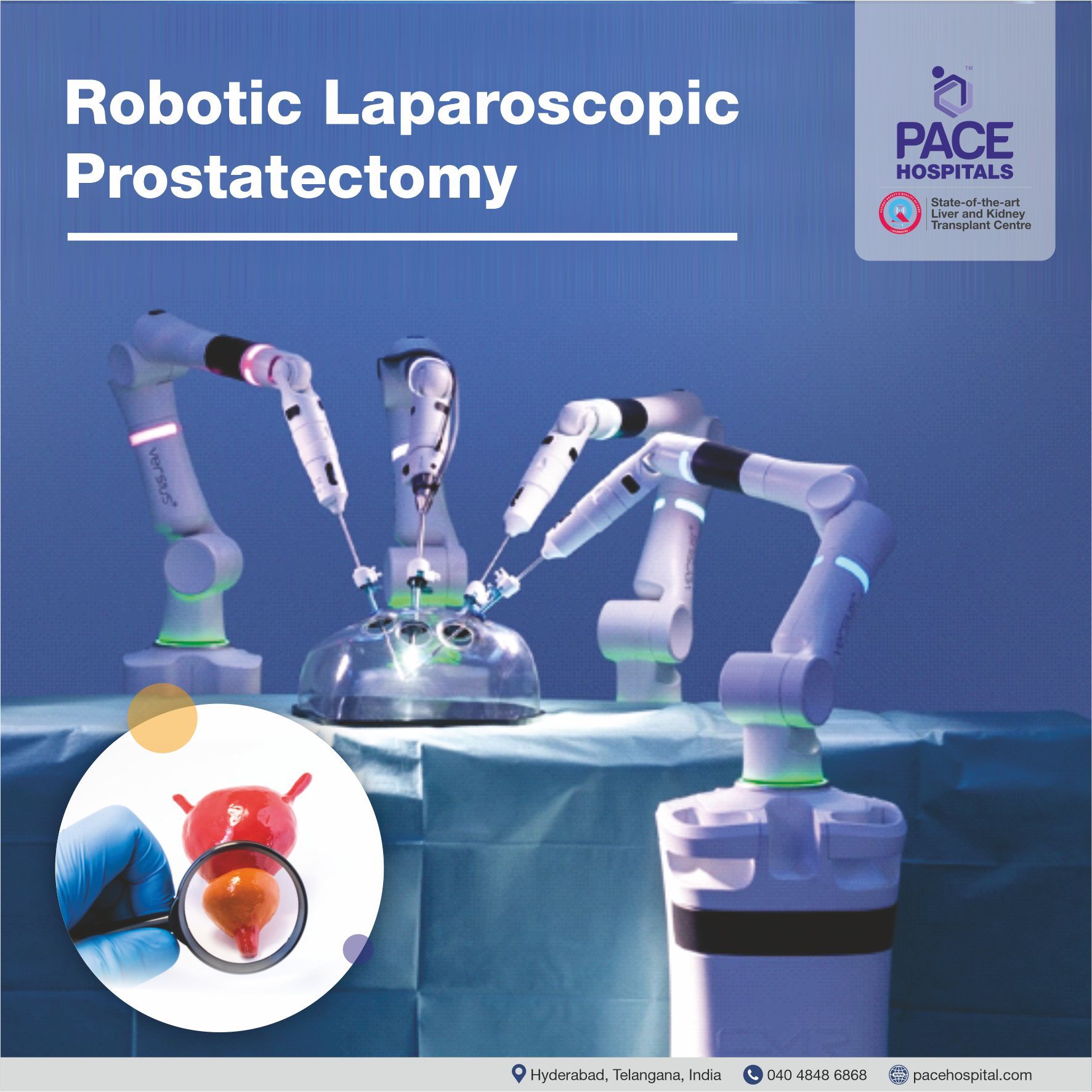 Robotic Laparoscopic Prostatectomy Surgery in Hyderabad, Pace Hospitals Robotic Laparoscopic Prostatectomy Surgery - Robotic Prostate Surgery in Hyderabad