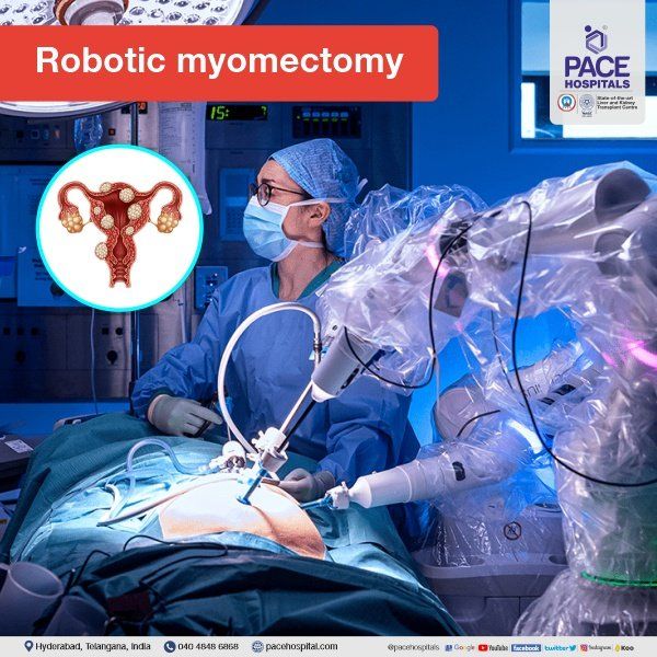Robotic Fibroid Surgery for Uterine Fibroids Treatment Robotic Myomectomy in Hyderabad | Robotic Fibroid Surgery | Uterine Fibroid Surgery