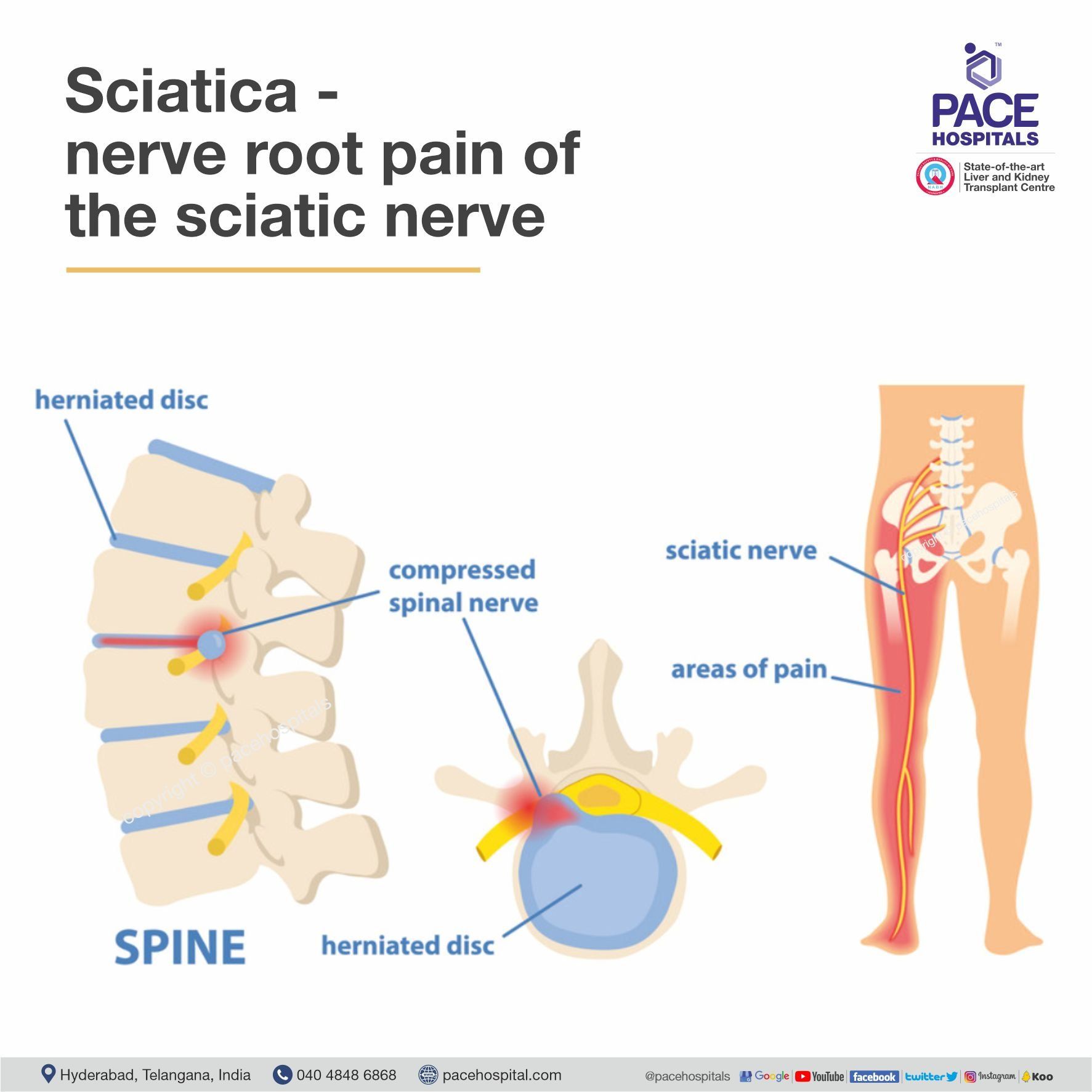 Sciatica (nerve root pain of the sciatic nerve) Sciatica (nerve root pain of the sciatic nerve)