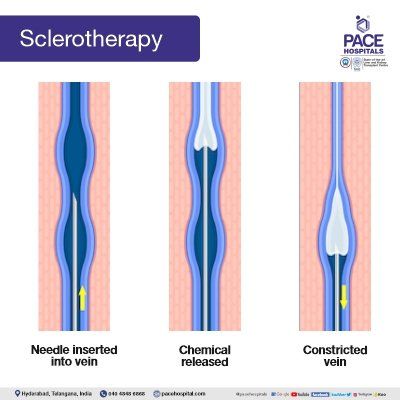 sclerotherapy sclerotherapy in hyderabad | varicose vein surgery - sclerotherapy for varicose veins