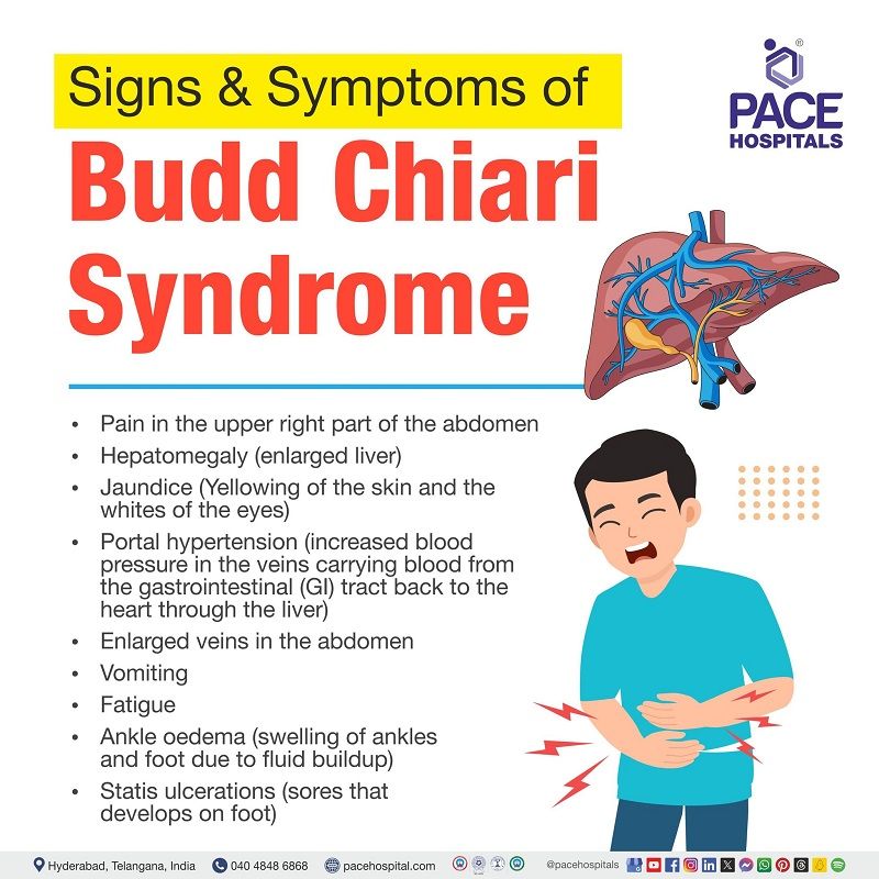 Signs and Symptoms of Budd-Chiari Syndrome budd chiari symptoms | Signs and Symptoms of Budd-Chiari Syndrome | symptoms of budd chiari syndrome | Visual depicting the signs and symptoms of Budd-Chiari syndrome