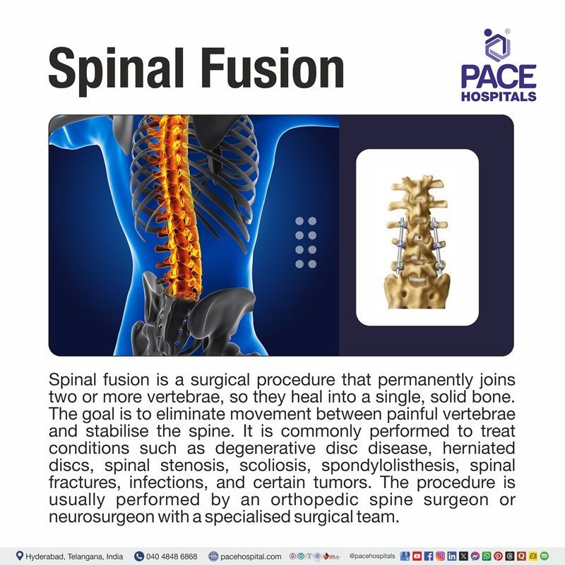 What is Spinal Fusion Surgery? What is Spinal surgery? | Spinal Fusion Surgery Procedure