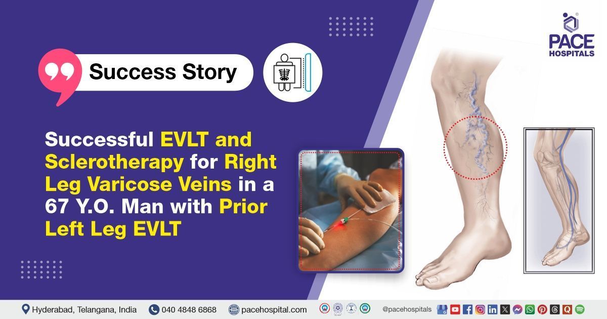 Successful EVLT & Sclerotherapy Procedure done for Varicose Veins Treatment at PACE Hospitals