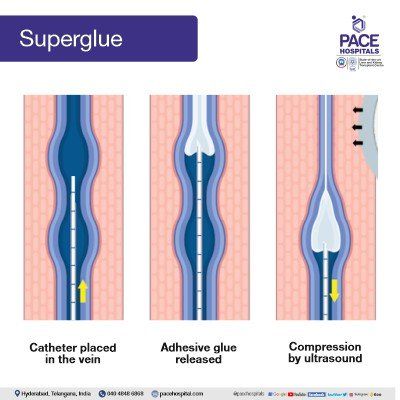 super glue treatment for varicose veins super glue treatment for varicose veins treatment in hyderabad | varicose vein surgery