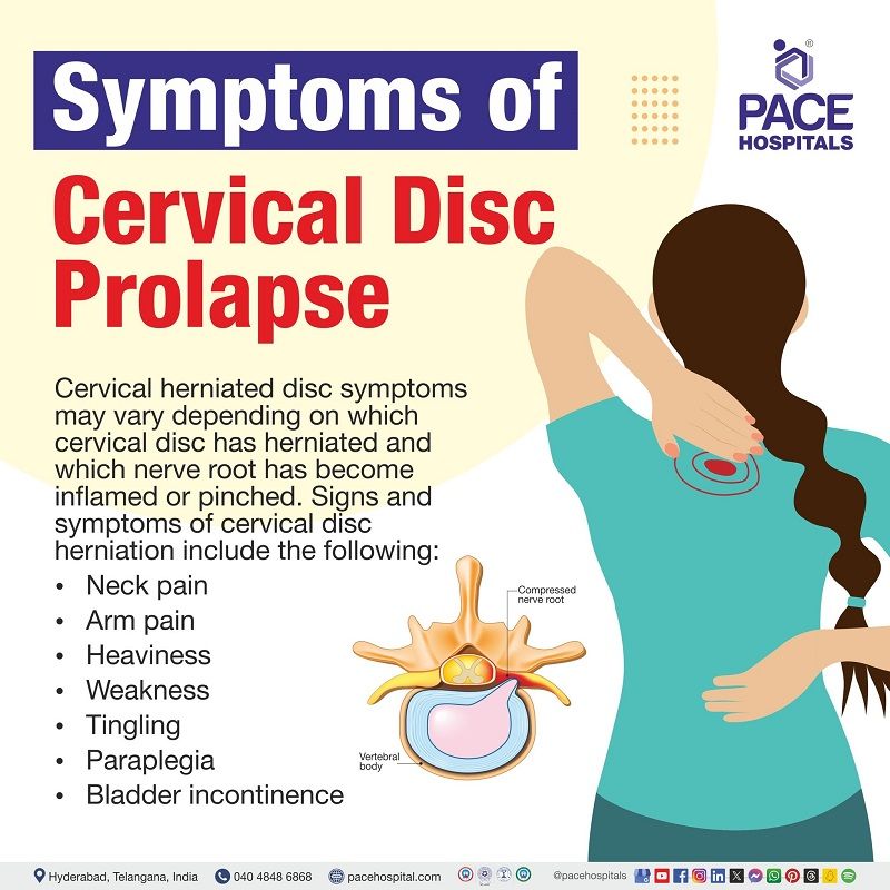 Cervical disc prolapse symptoms Cervical disc prolapse symptoms | symptoms of Cervical disc prolapse | cervical disc prolapse symptoms and signs | Visual depicting the symptoms of cervical disc prolapse