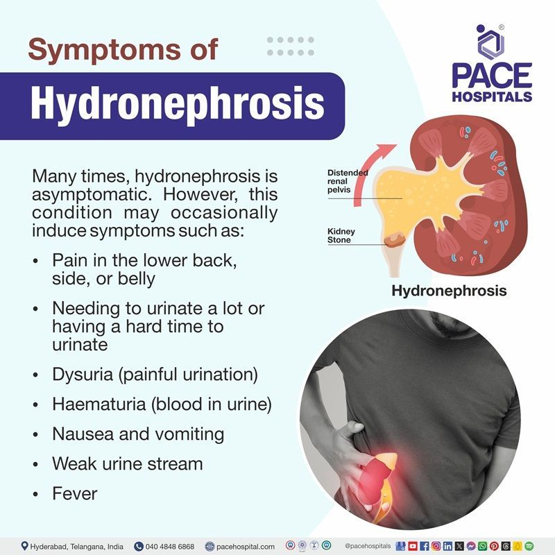 Signs and symptoms of hydronephrosis hydronephrosis signs and symptoms | hydronephrosis symptoms | hydronephrosis symptoms in adults, females & babies | hydronephrosis in infants symptoms