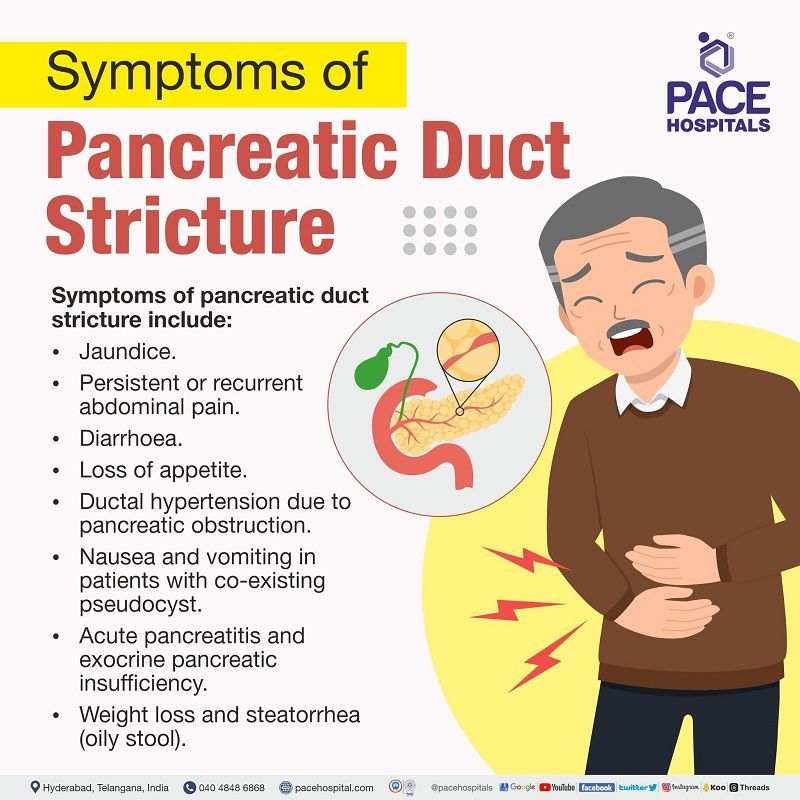 Pancreatic Duct Stricture Symptoms Symptoms of Pancreatic Duct Strictures | Benign and Malignant Pancreatic Ductal Strictures Symptoms