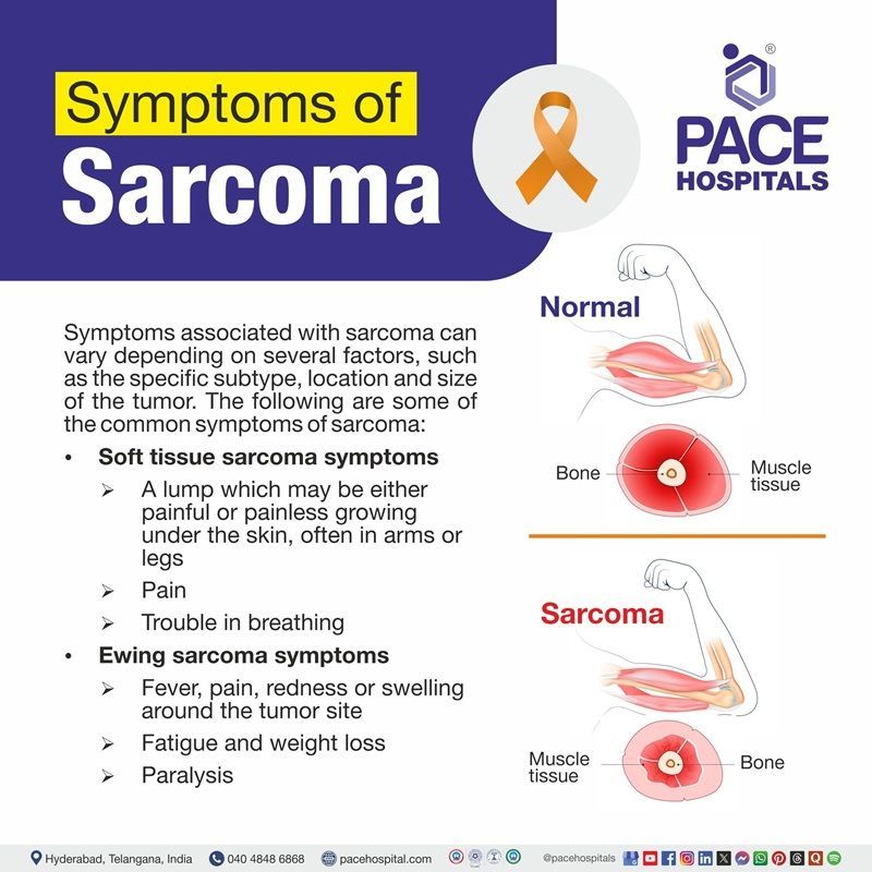 Sarcoma symptoms Sarcoma symptoms | Visual depicting the various sarcoma symptoms