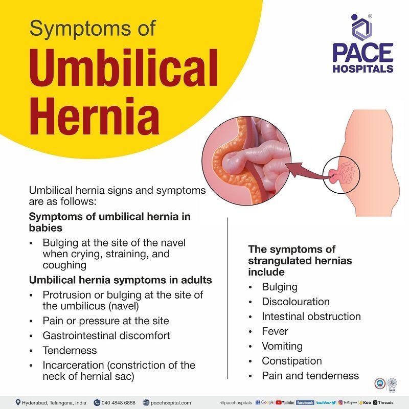 Umbilical Hernia signs and symptoms symptoms of umbilical hernia, India | signs of umbilical hernia | umbilical hernia symptoms in newborns | symptoms of umbilical hernia in adults | strangulated umbilical hernia symptoms | paraumbilical hernia symptoms