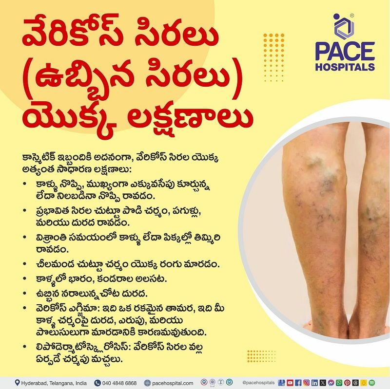 Symptoms of Varicose veins in Telugu Symptoms of Varicose veins in Telugu | లో వెరికోస్ వెయిన్స్ యొక్క లక్షణాలు | what are the symptoms of varicose veins in Telugu | Varicose veins symptoms in Telugu | అనారోగ్య సిరలు లక్షణాలు