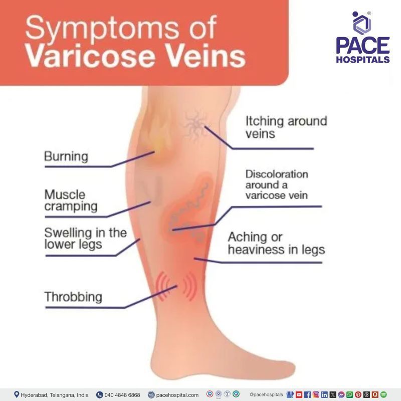 varicose veins symptoms | symptoms of varicose veins