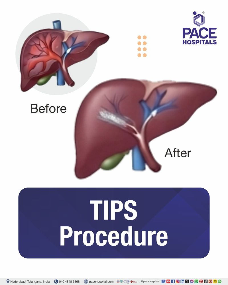 TIPS Procedure Cost in Hyderabad | Affordable Transjugular Intrahepatic Portosystemic Shunt Procedure in India