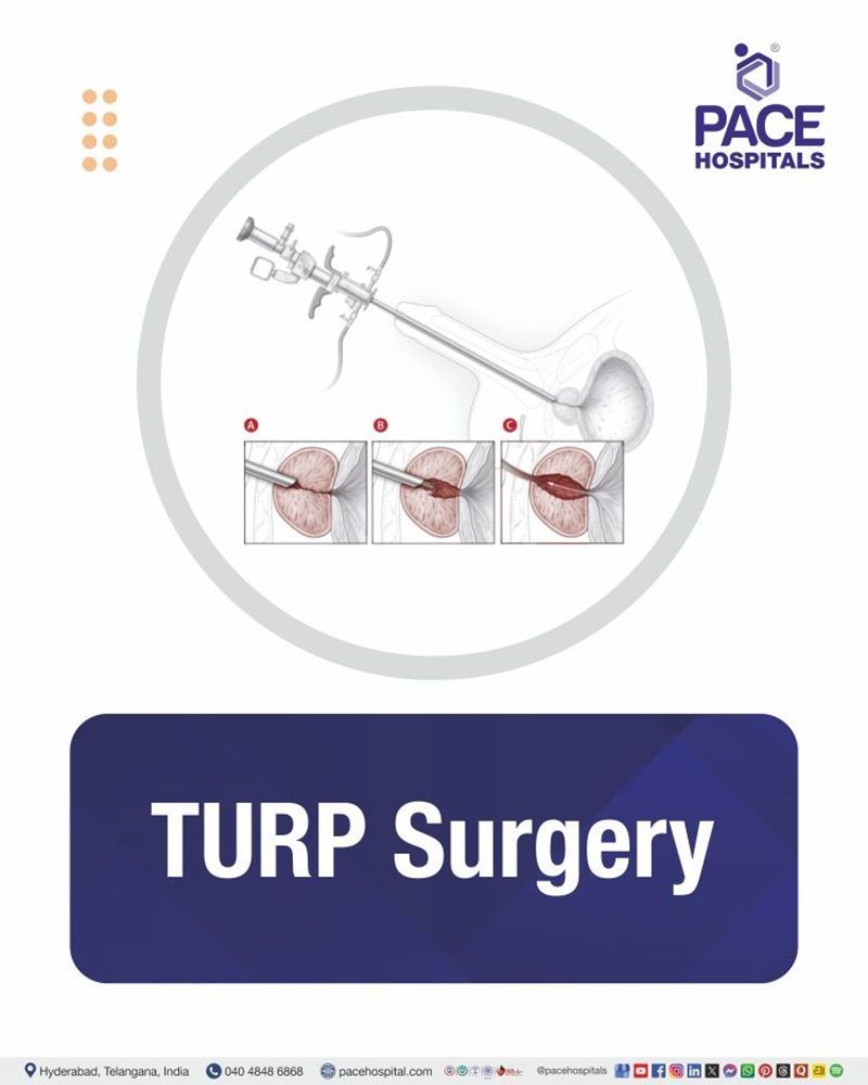 TURP Surgery Cost in Hyderabad | Affordable TURP Surgery in India
