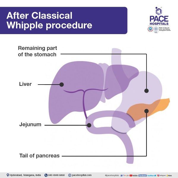 Classical or Conventional Whipple procedure for pancreatic cancer | whipple surgery