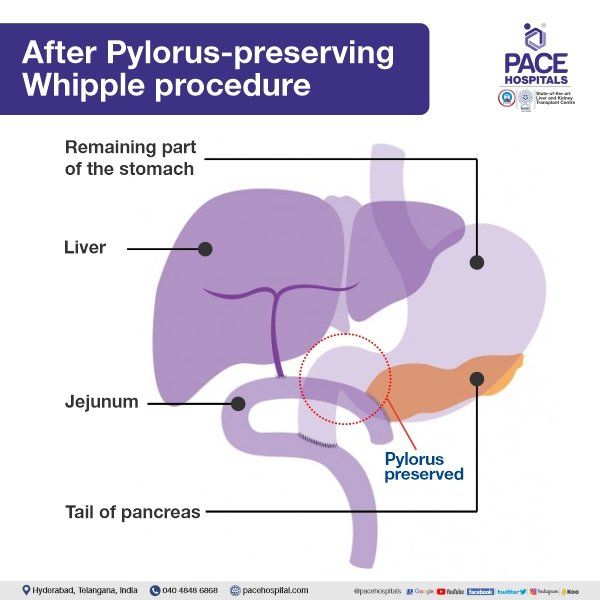 Pylorus-preserving whipple procedure for ampullary cancer | whipple surgery