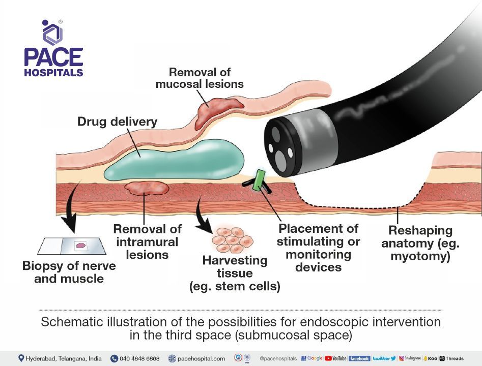 Possibilities for endoscopic intervention in the third space Third space endoscopy indications | Third Space Endoscopy technique in Hyderabad, India | possibilities for endoscopic intervention in the third space