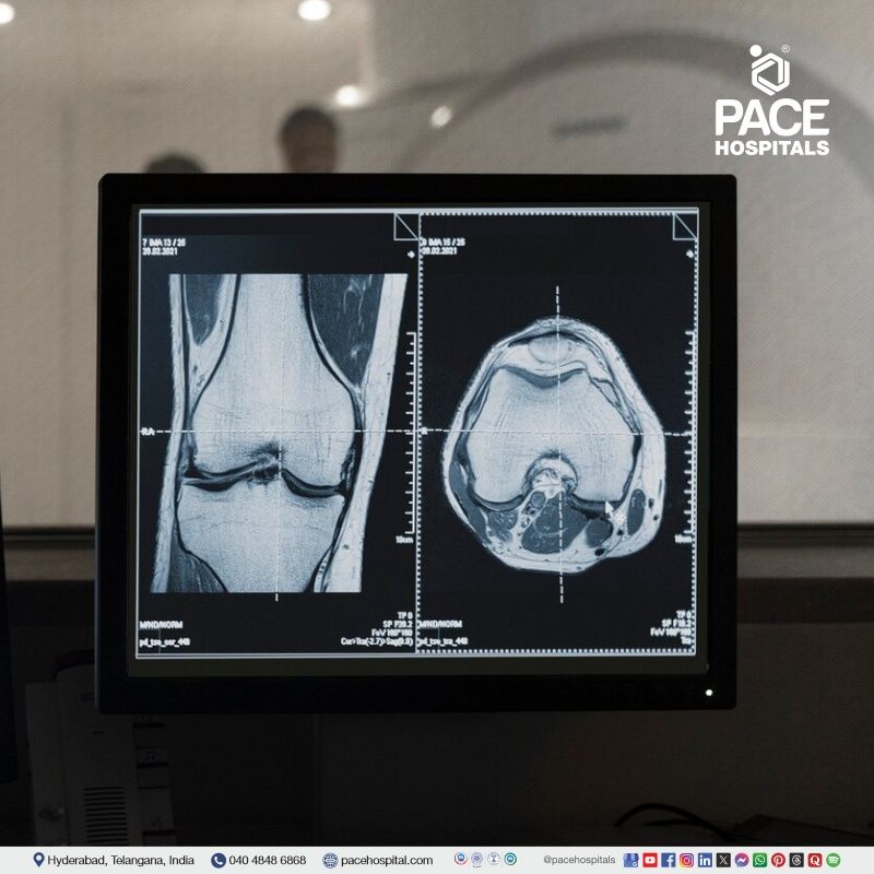 Best Sports Injury Diagnosis Hospital in Hyderabad, Telangana, India Advanced Sports injury diagnosis at the leading sports medicine hospital in Hyderabad, Telangana, India.