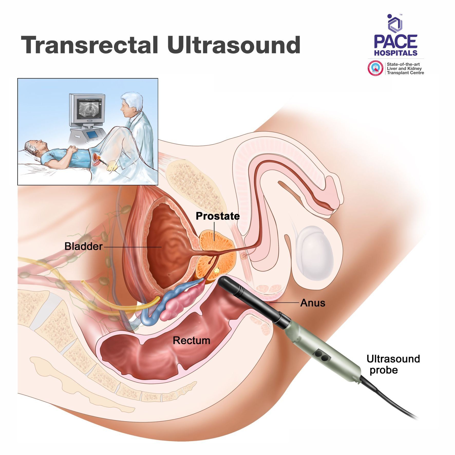 Transrectal ultrasound Transrectal ultrasound - Diagnosis of Prostate Cancer