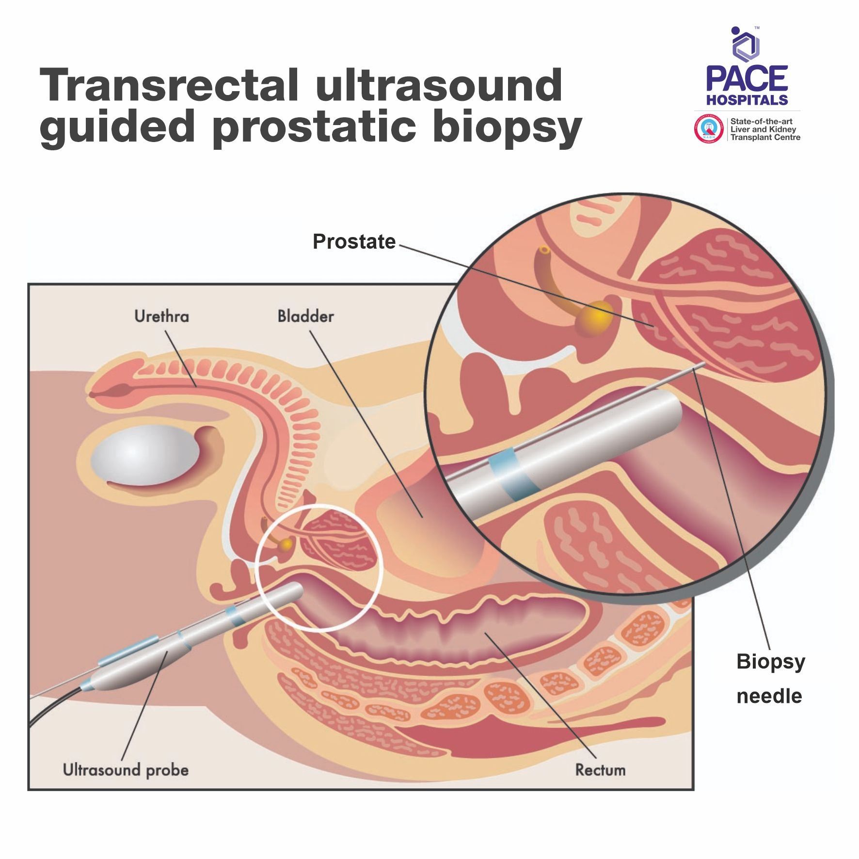 Transrectal ultrasound guided prostatic biopsy Transrectal ultrasound guided prostatic biopsy - Diagnosis of Prostate Cancer