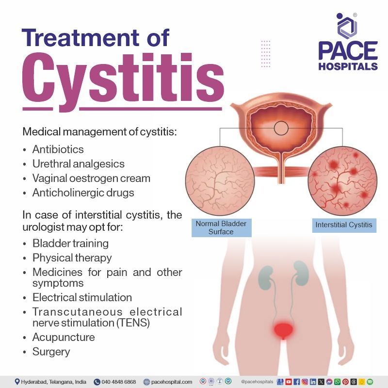 Cystitis treatment cystitis treatment | interstitial cystitis treatment | chronic cystitis treatment | what is the best treatment for cystitis | Visual suggesting Cystitis treatment