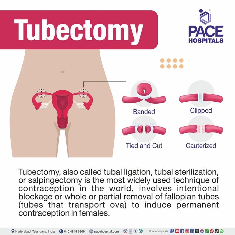 What is Tubectomy (Tubal Ligation) Surgery or Operation Tubectomy Surgery meaning | Tubectomy Procedure in Hyderabad, India | tubal ligation operation near me